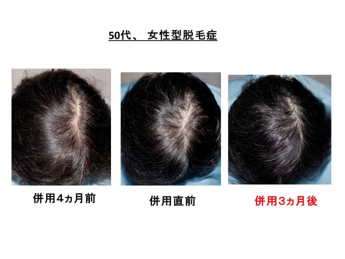 円形脱毛症　病院